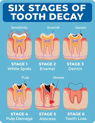 🦷 Dentite Tooth Armor – Invisible Daily Defense 💧